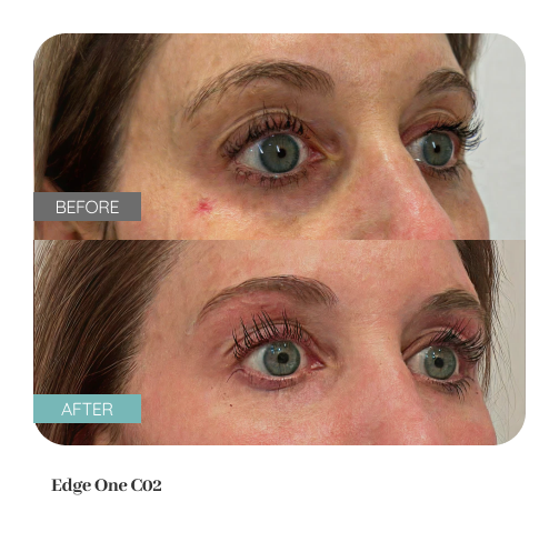 Before and after treatment result — Dr. Lanna, LC Medical Aesthetics NYC
